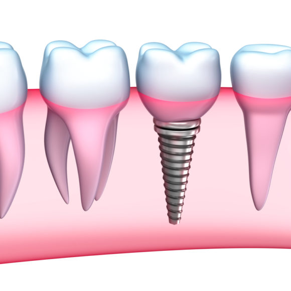 Dental Implants