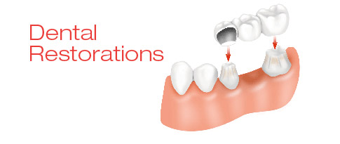 Dental Restorations