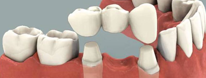 Dental Crowns and Dental Bridges