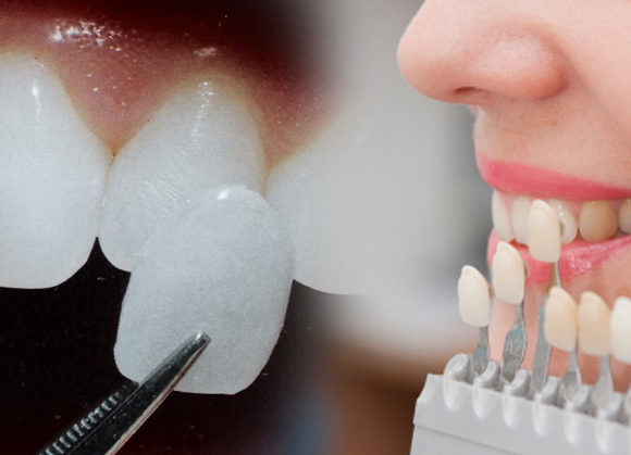Dental Veneers and Laminates